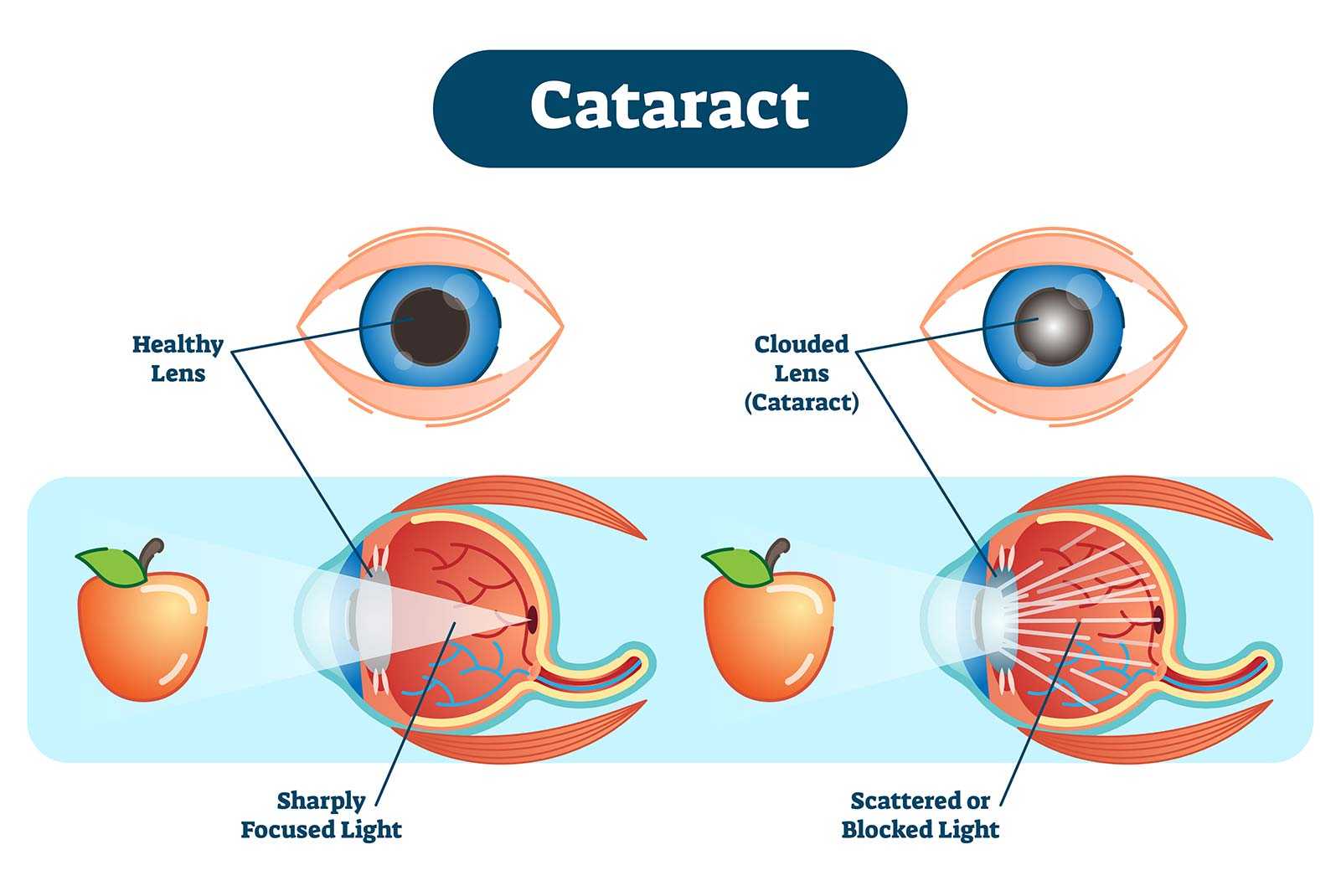 Cataract Surgery in Noida Cost Get Best Price at Vision Plus